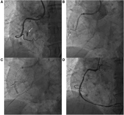 Case report: Constrictive pericarditis after coronary artery perforation during percutaneous coronary intervention